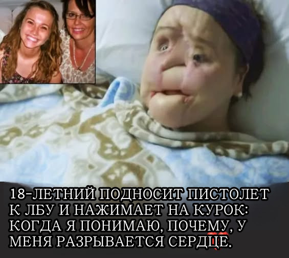 Удивительная история Кэти Стабблфилд: она стала самым молодым человеком, получившим пересадку лица.