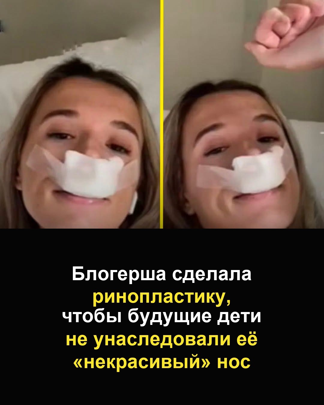 Тиктокерша сделала ринопластику ради будущих детей