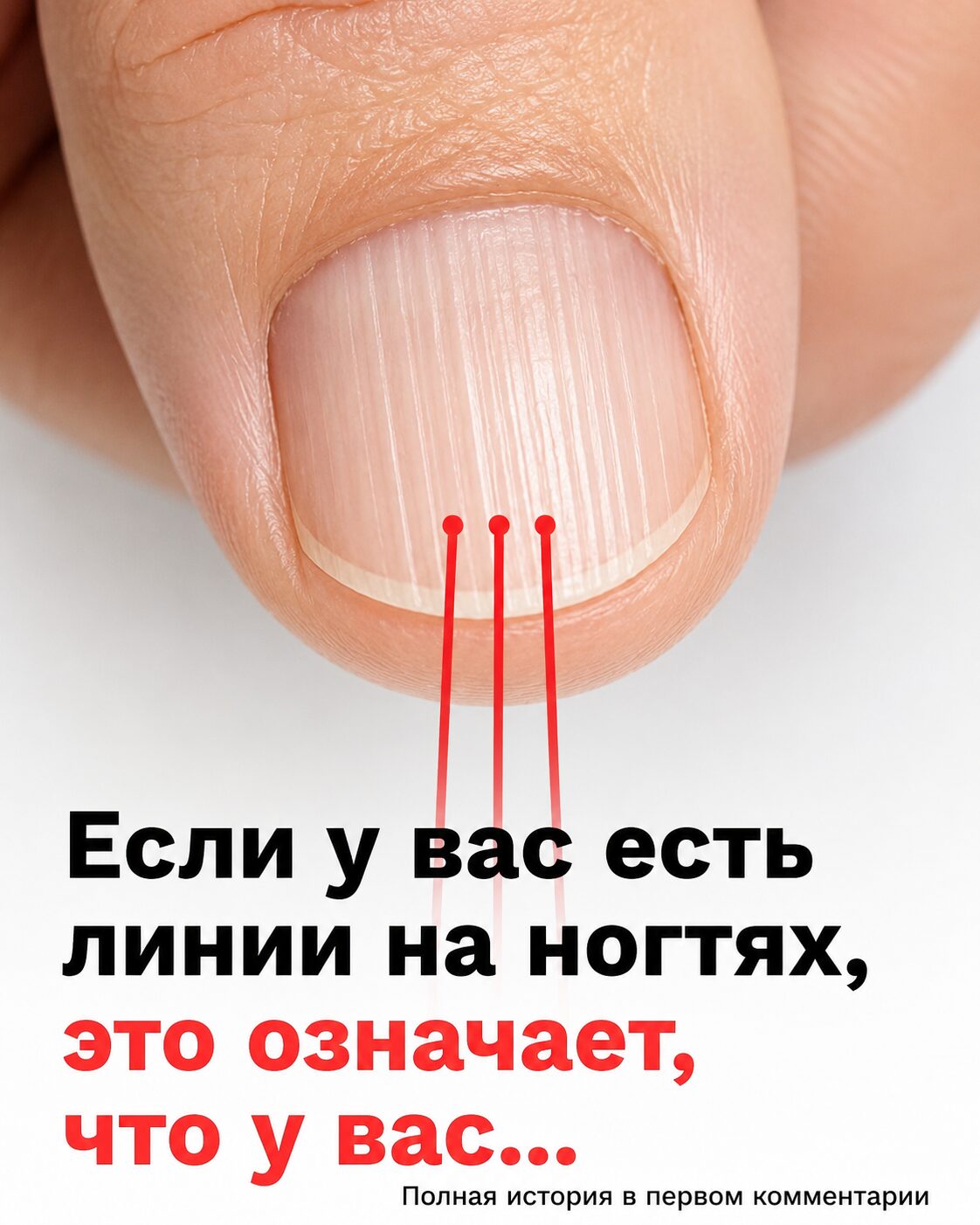 Вертикальные полосы на ногтях: когда это возрастная особенность, а когда повод провериться
