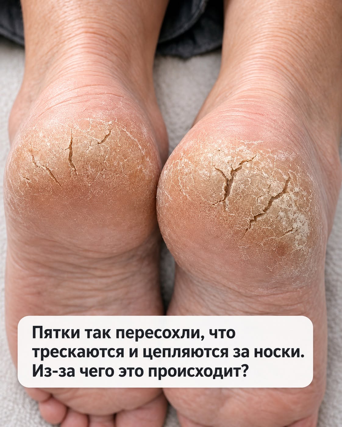 Почему пятки становятся сухими и трескаются